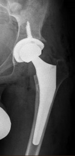 Example of a hip replacement x-ray