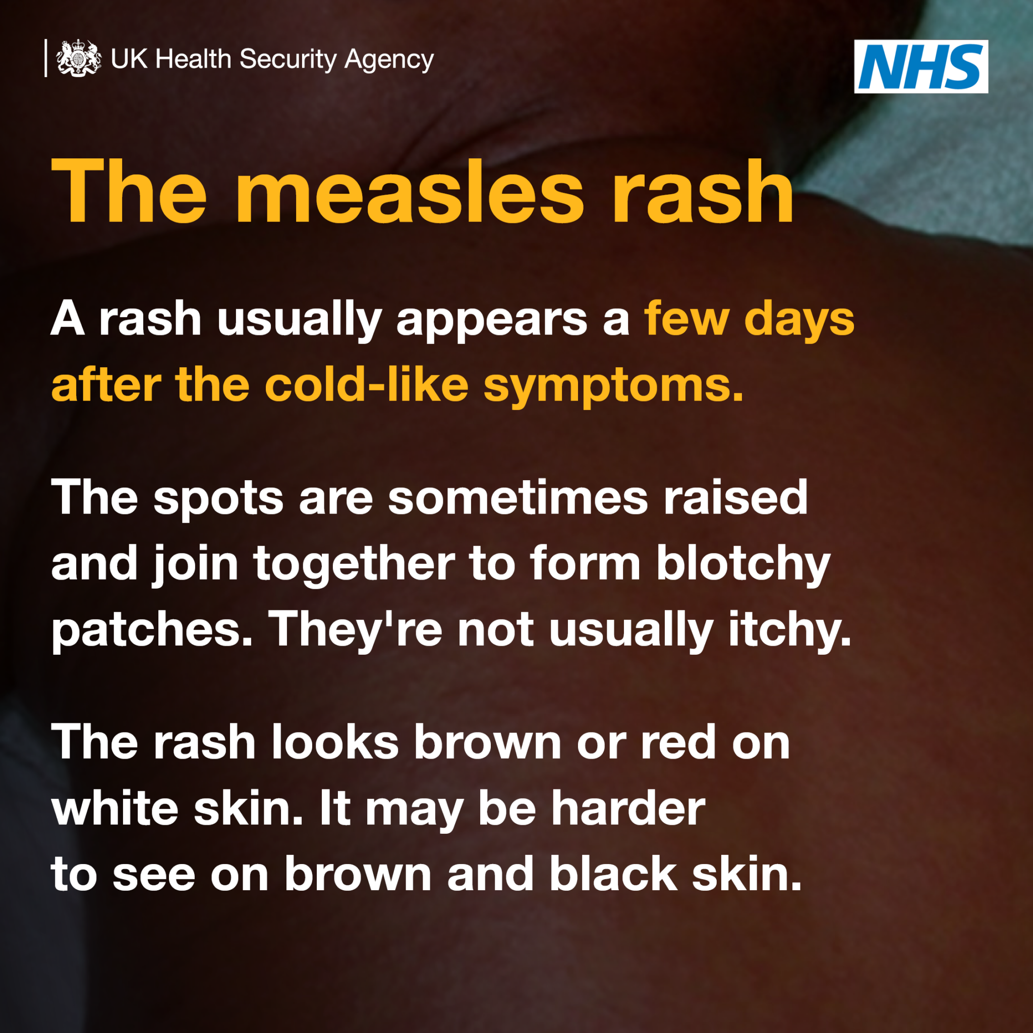 Measles cases rising in England - Alder Hey Children's Hospital Trust