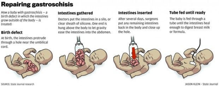 Gastroschisis - Alder Hey Children's Hospital Trust