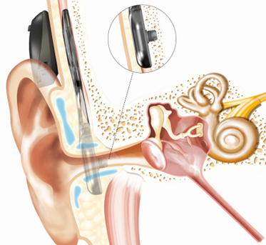 Diagram of Osia active transctaneous BCI. Image courtesy of Cochlear, 2022