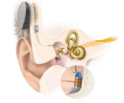 Diagram Vibrant Soundbridge middle ear implant.  Image courtesy of Medel, 2022